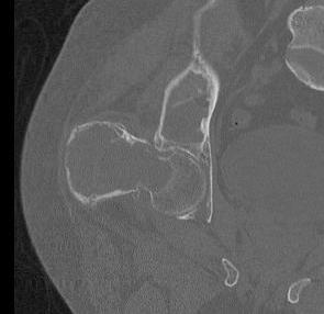 Fibrous Dysplasia Hip CT